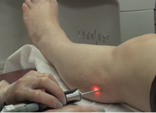 Laser Vein Removal: What to Expect Before, During, and After Your Procedure